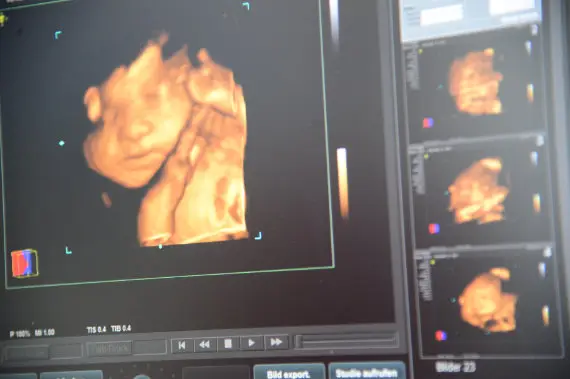 Unser 3D und 4D Ultraschallgerät.